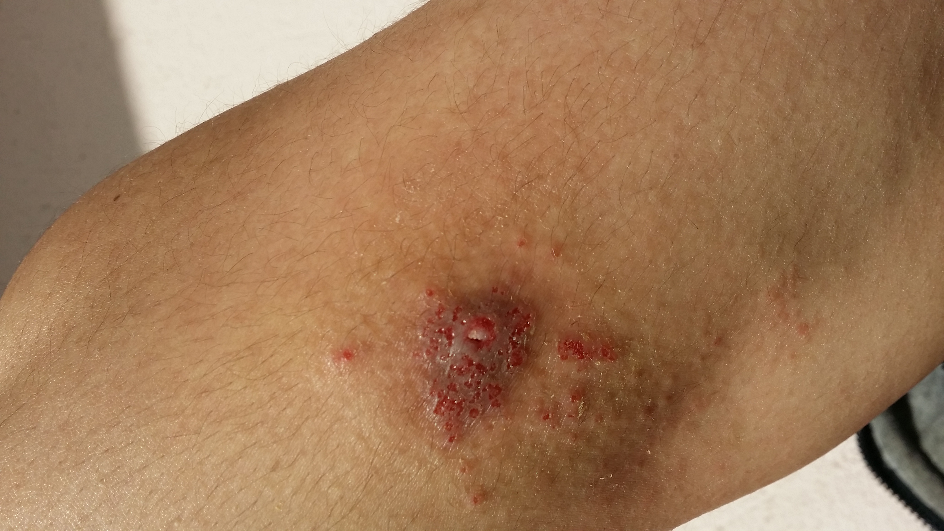 Zeckenbiss Welche Art von Wunde ist das? (Krankheit, Haut, Verletzung)